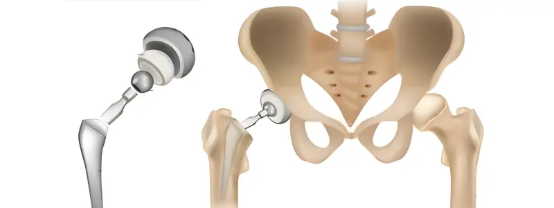 Partial Hip Replacement Hospital in Ahmedabad