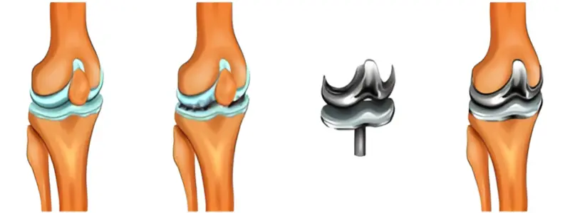 Illustration of a knee joint with arthritis and a knee implant