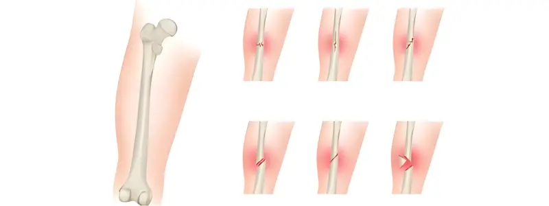 Orthopedic Trauma & Fracture Hospital in Ahmedabad