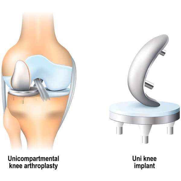 partial_knee_replacement