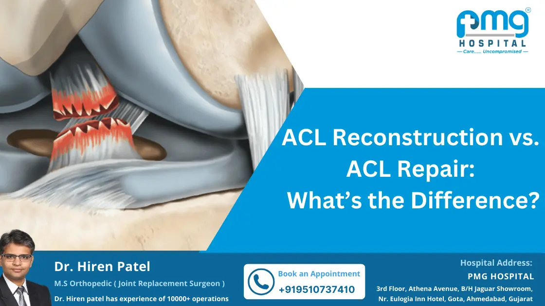 ACL Reconstruction vs. ACL Repair: What&rsquo;s the Difference? - PMG 