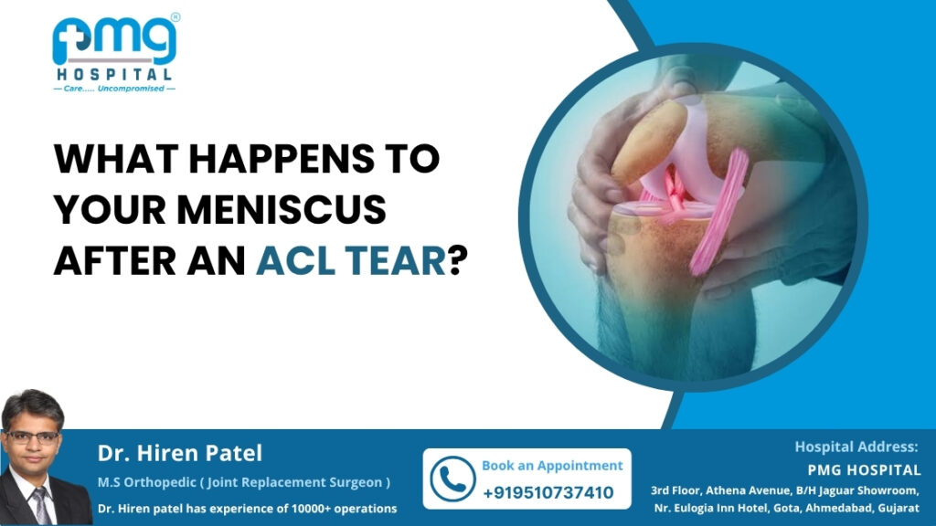 What Happens to Your Meniscus After an ACL Tear?