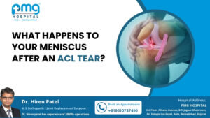 What Happens to Your Meniscus After an ACL Tear?
