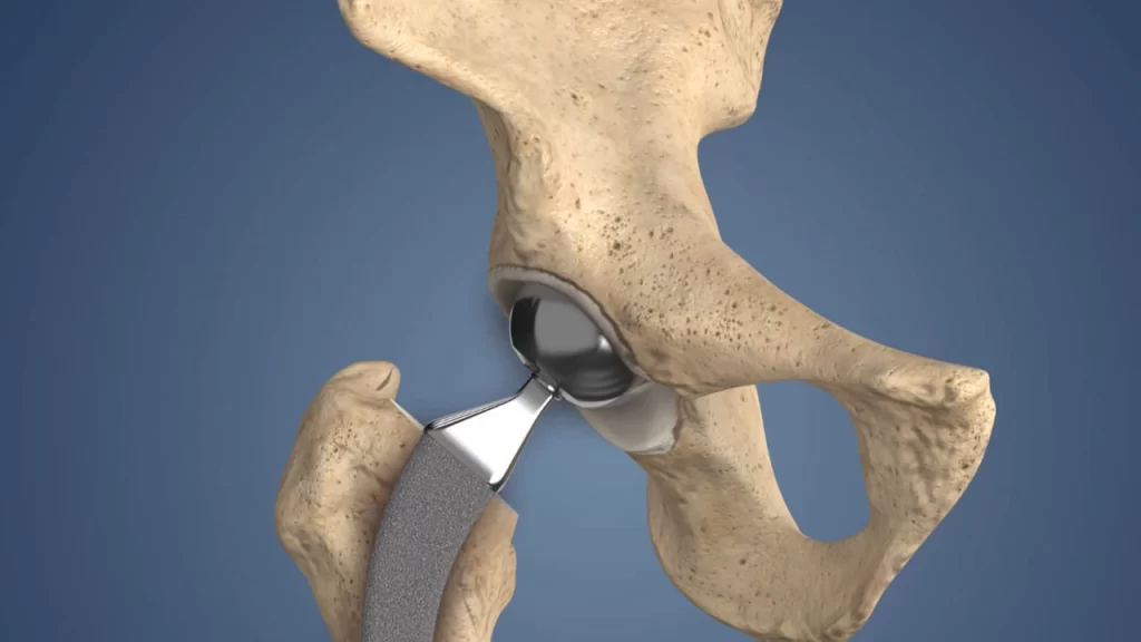 Partial Hip Replacement